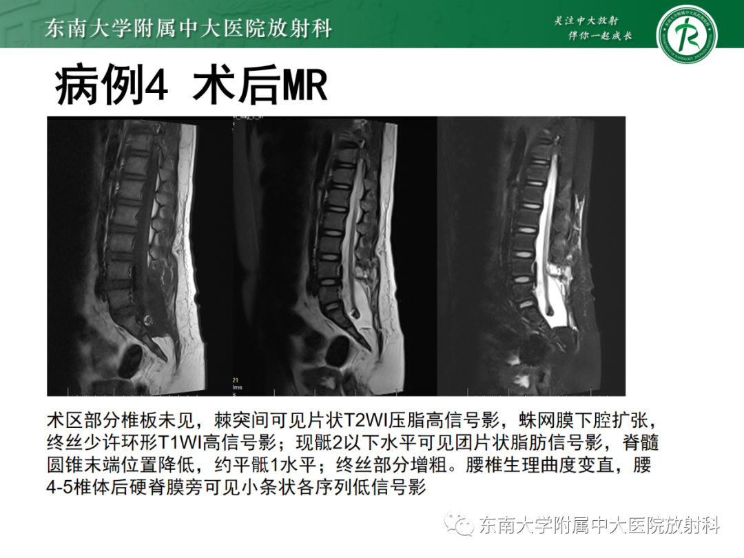 影像PPT - 【PPT】脊髓栓系综合征-35 影像PPT - 【PPT】脊髓栓系综合征-35