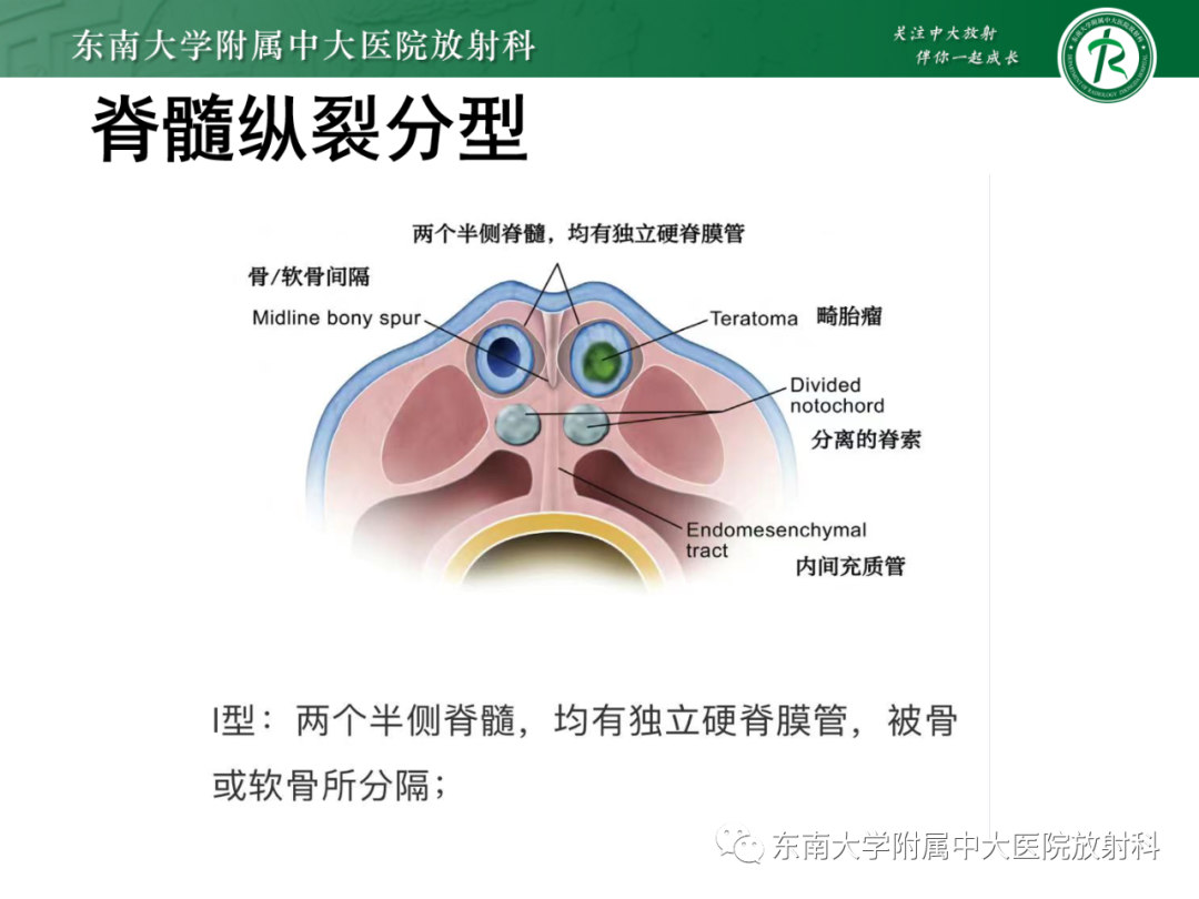 影像PPT - 【PPT】脊髓栓系综合征-37 影像PPT - 【PPT】脊髓栓系综合征-37