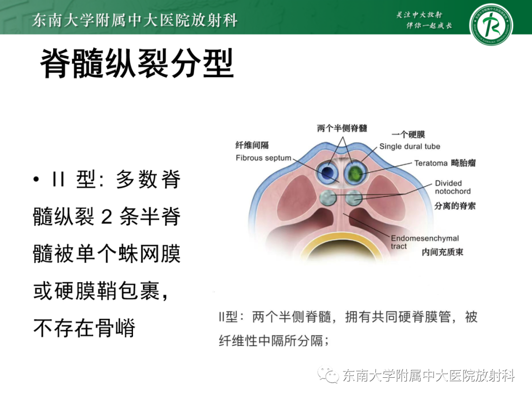 影像PPT - 【PPT】脊髓栓系综合征-38 影像PPT - 【PPT】脊髓栓系综合征-38