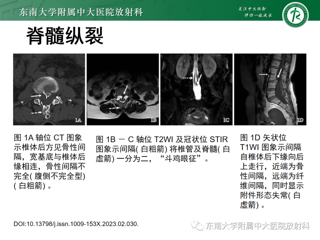 影像PPT - 【PPT】脊髓栓系综合征-39 影像PPT - 【PPT】脊髓栓系综合征-39