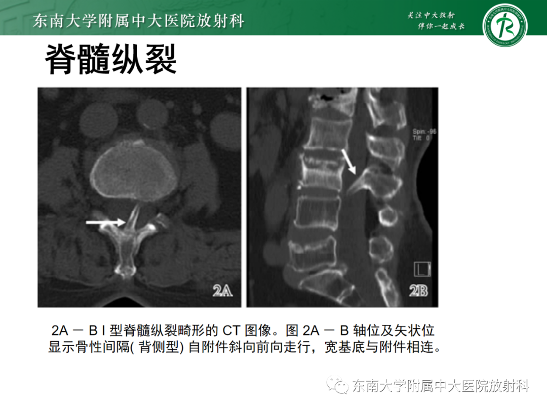 影像PPT - 【PPT】脊髓栓系综合征-40 影像PPT - 【PPT】脊髓栓系综合征-40