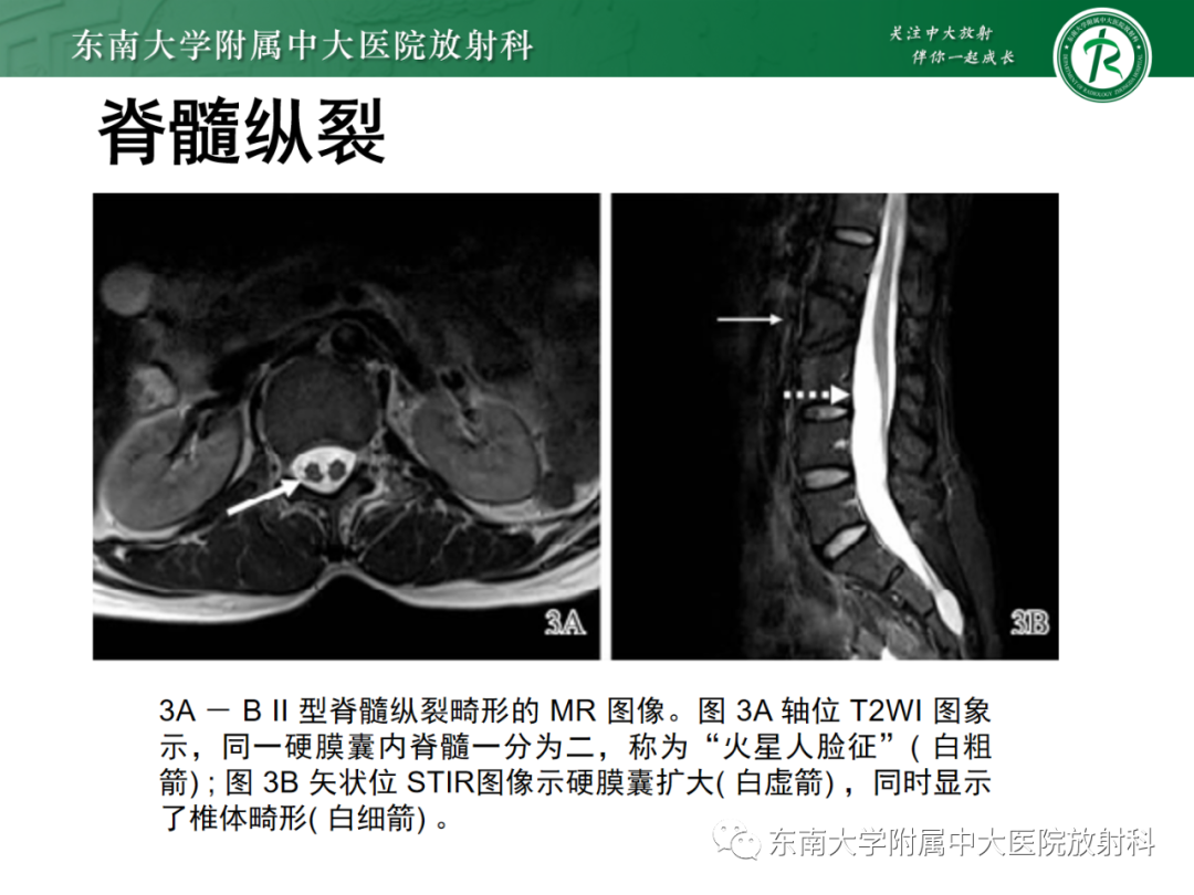 影像PPT - 【PPT】脊髓栓系综合征-41 影像PPT - 【PPT】脊髓栓系综合征-41