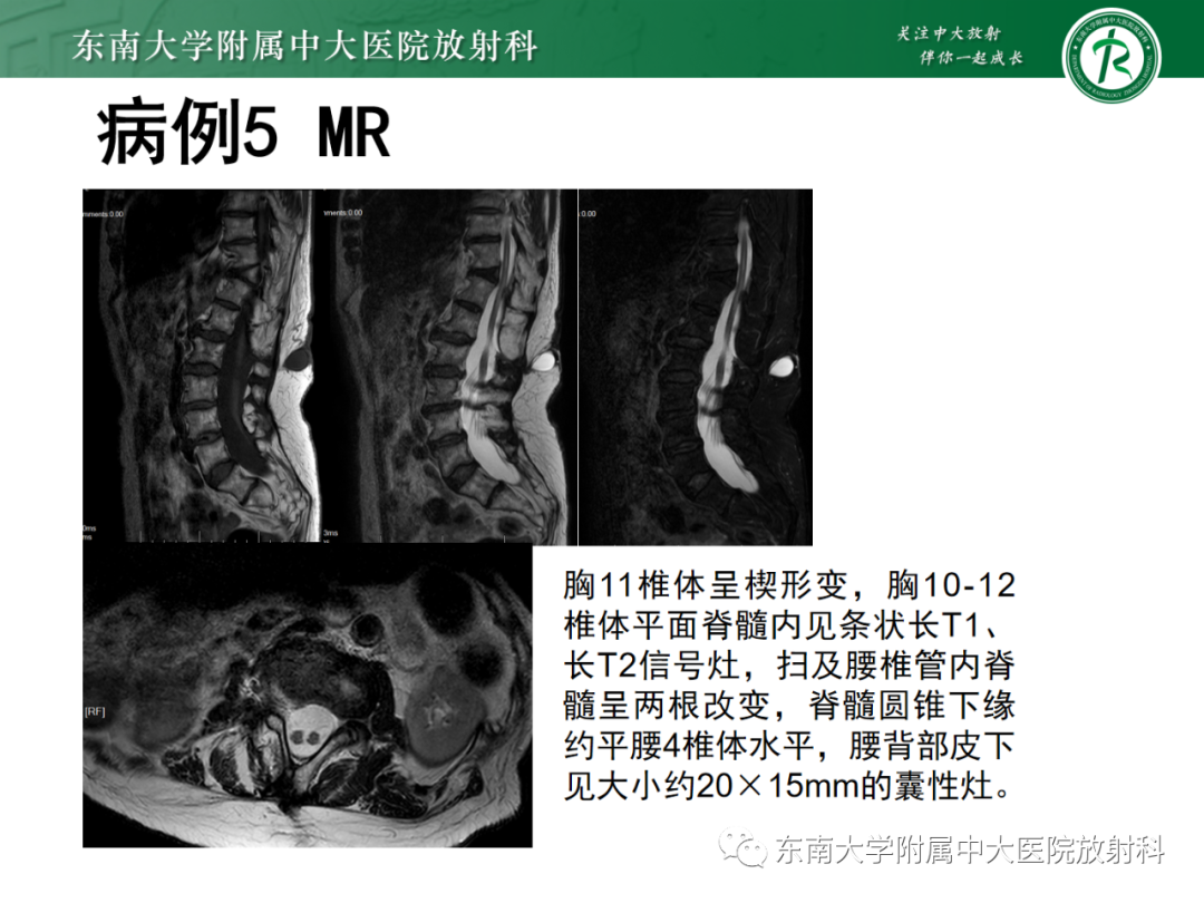影像PPT - 【PPT】脊髓栓系综合征-43 影像PPT - 【PPT】脊髓栓系综合征-43