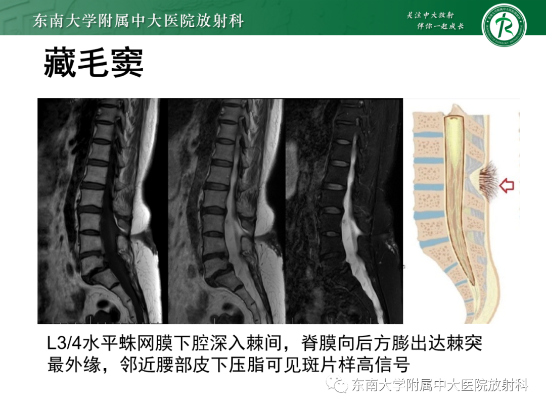 影像PPT - 【PPT】脊髓栓系综合征-44 影像PPT - 【PPT】脊髓栓系综合征-44