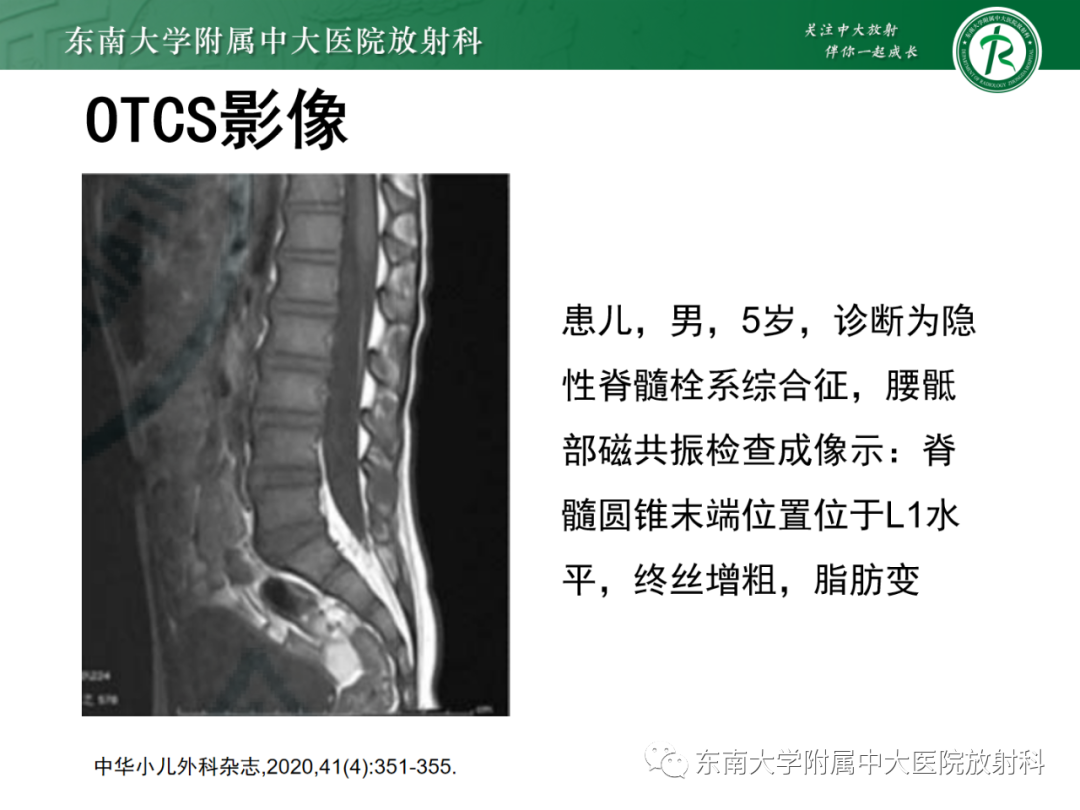 影像PPT - 【PPT】脊髓栓系综合征-47 影像PPT - 【PPT】脊髓栓系综合征-47