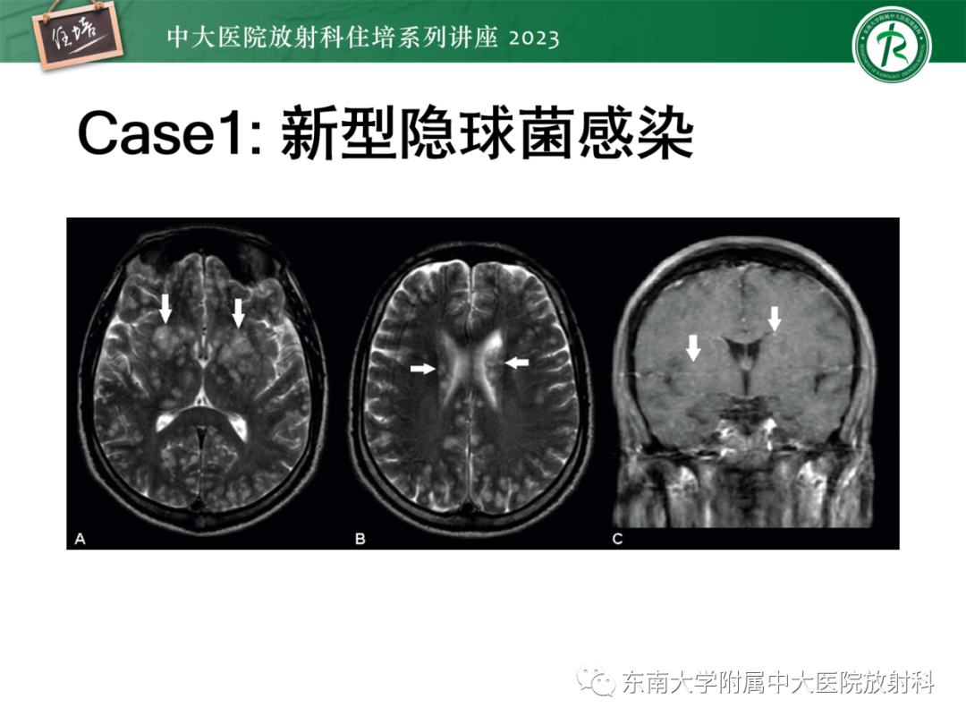 影像PPT - 【PPT】中枢神经系统真菌感染影像诊断-2