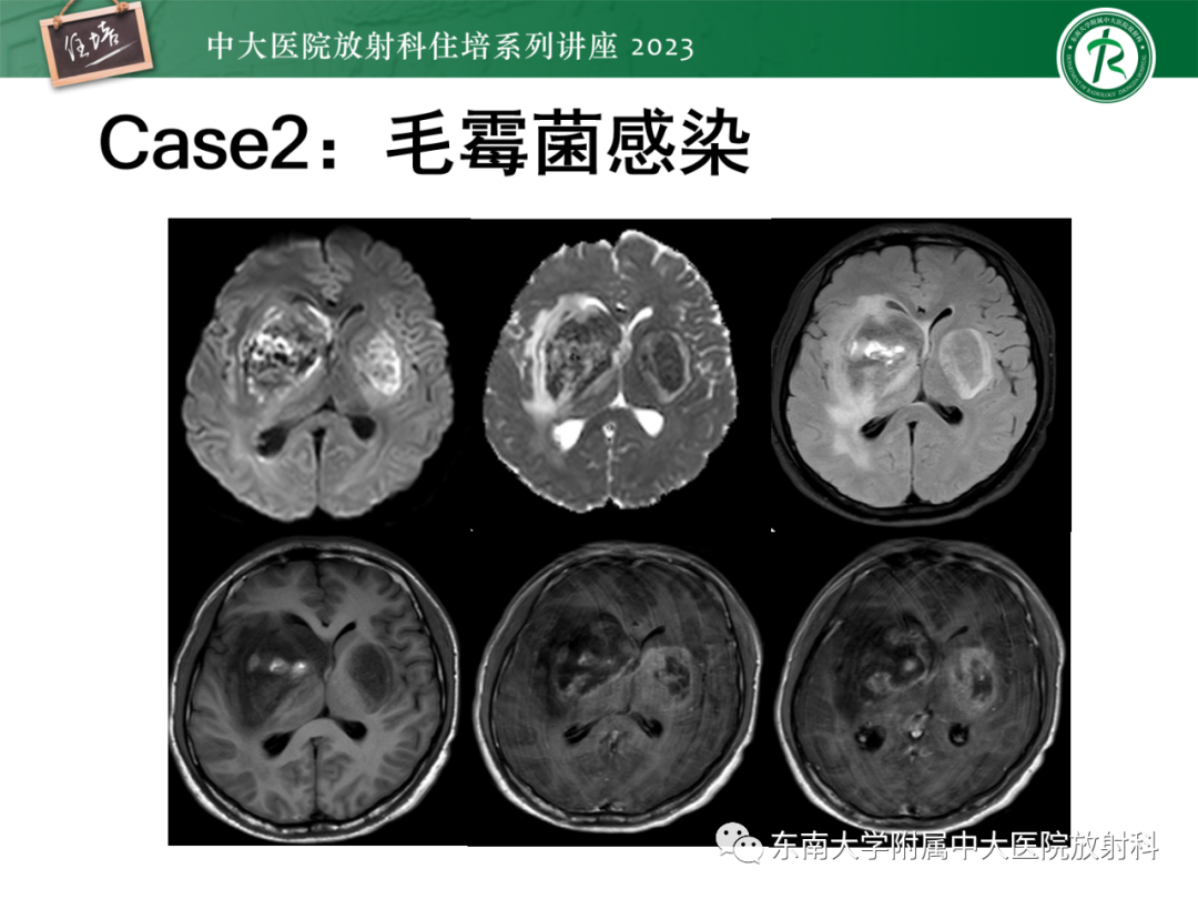 影像PPT - 【PPT】中枢神经系统真菌感染影像诊断-3