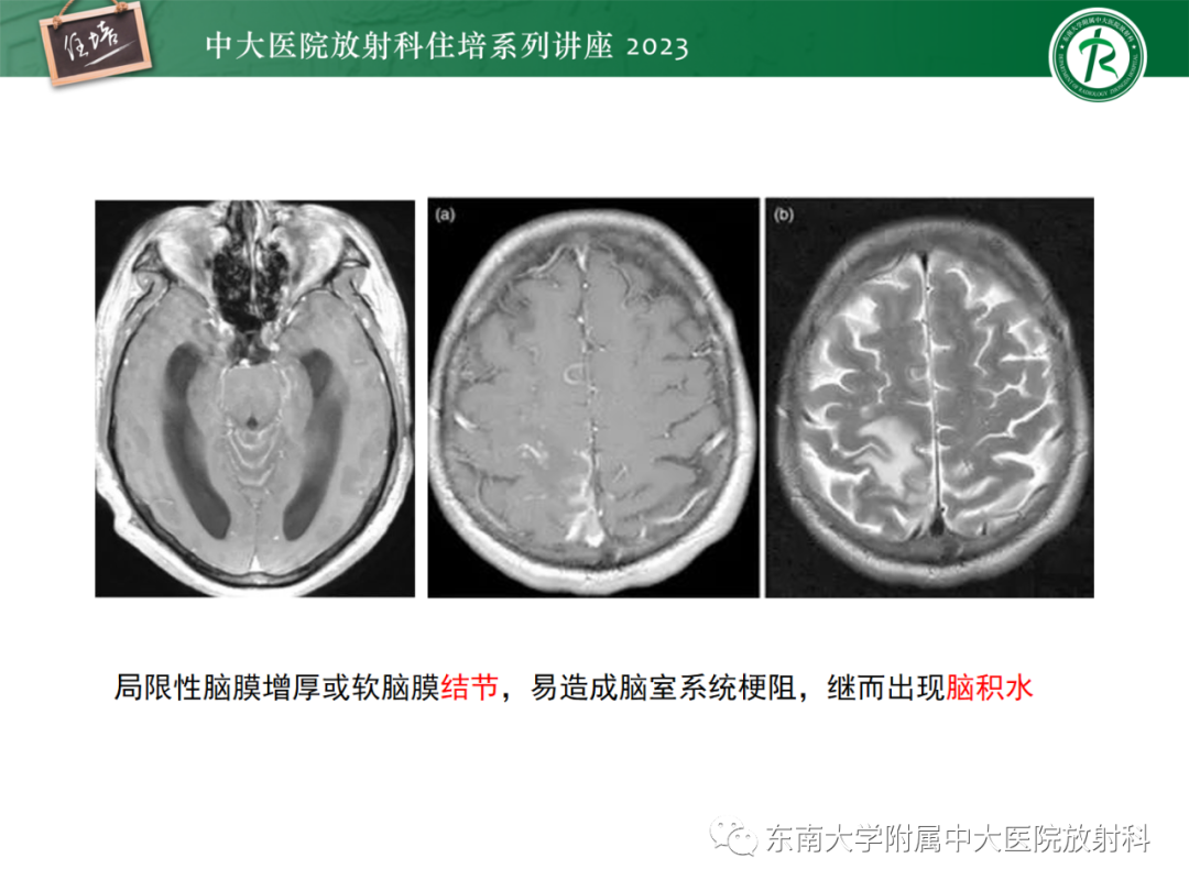 影像PPT - 【PPT】中枢神经系统真菌感染影像诊断-13