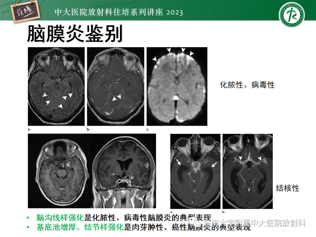 影像PPT - 【PPT】中枢神经系统真菌感染影像诊断-14
