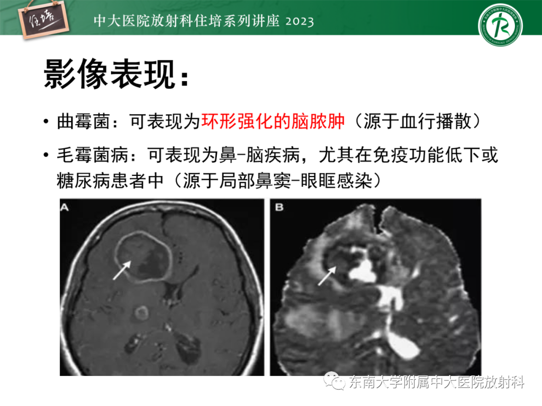 影像PPT - 【PPT】中枢神经系统真菌感染影像诊断-16