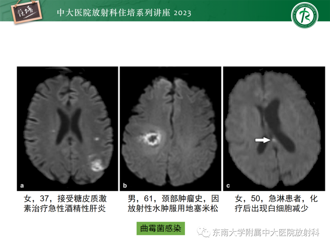 影像PPT - 【PPT】中枢神经系统真菌感染影像诊断-17