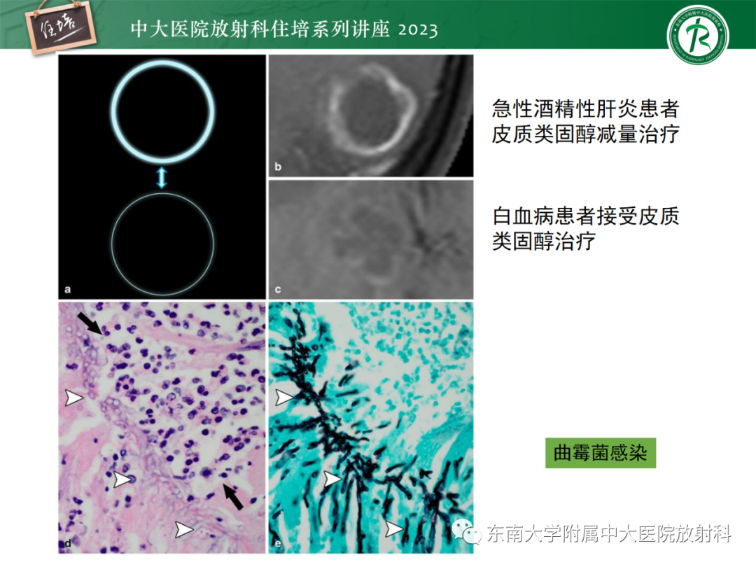 影像PPT - 【PPT】中枢神经系统真菌感染影像诊断-18