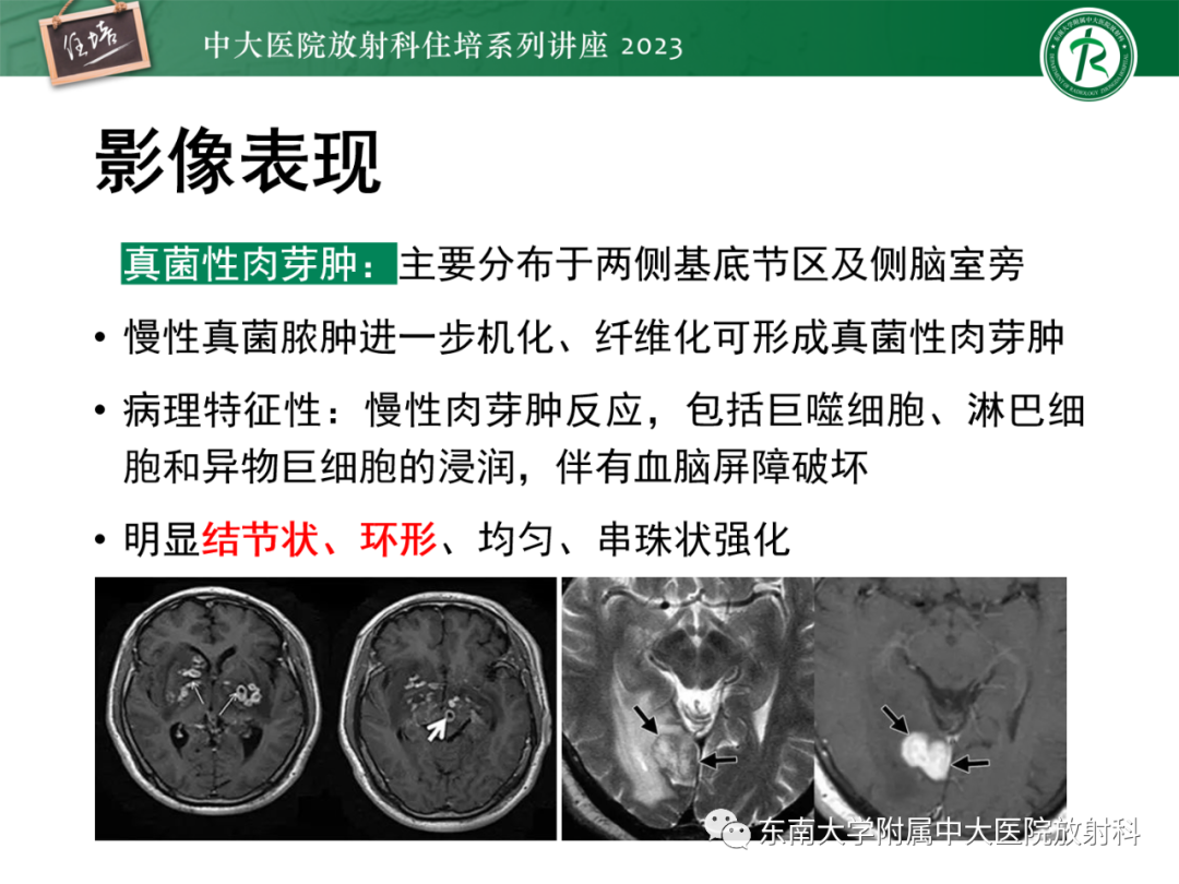 影像PPT - 【PPT】中枢神经系统真菌感染影像诊断-19