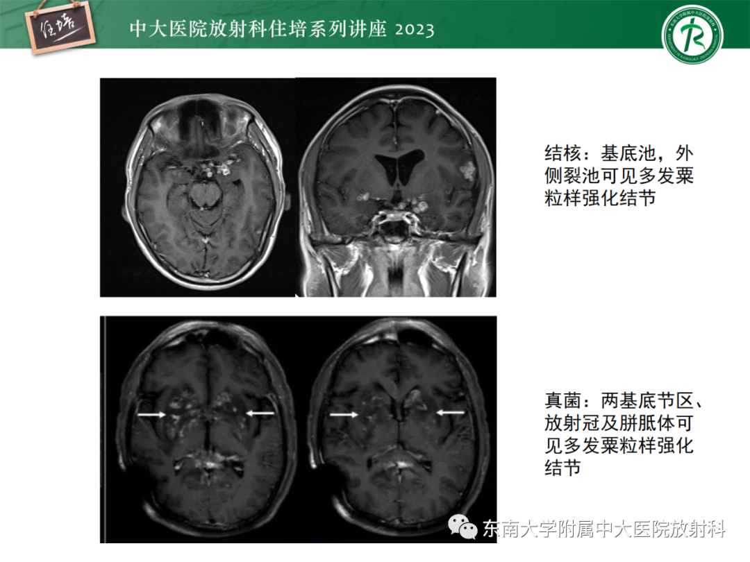 影像PPT - 【PPT】中枢神经系统真菌感染影像诊断-20