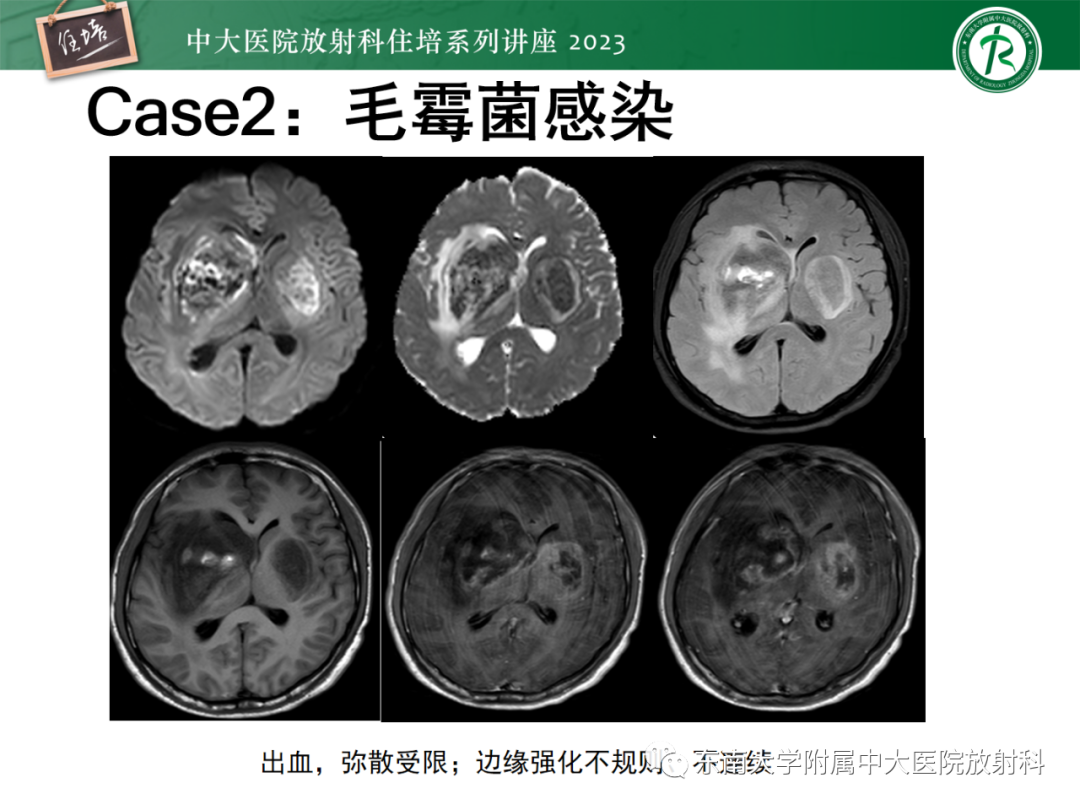 影像PPT - 【PPT】中枢神经系统真菌感染影像诊断-22