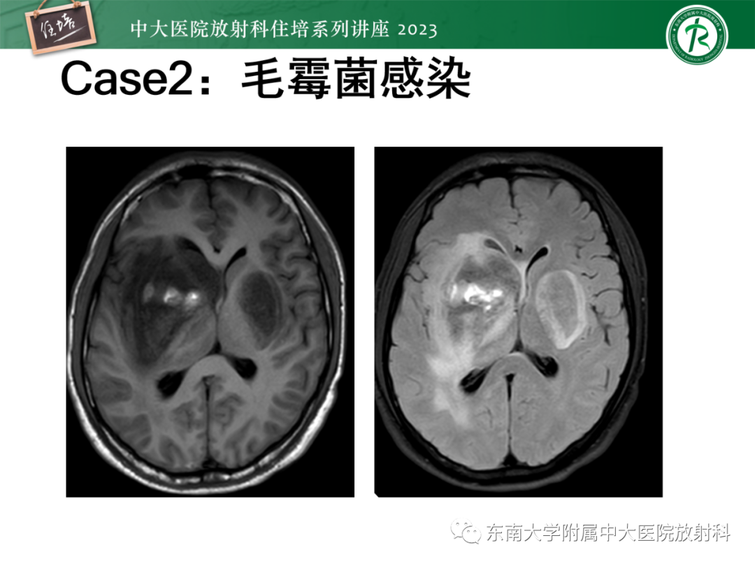 影像PPT - 【PPT】中枢神经系统真菌感染影像诊断-23