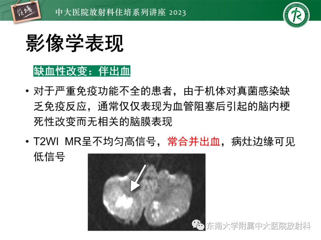 影像PPT - 【PPT】中枢神经系统真菌感染影像诊断-24