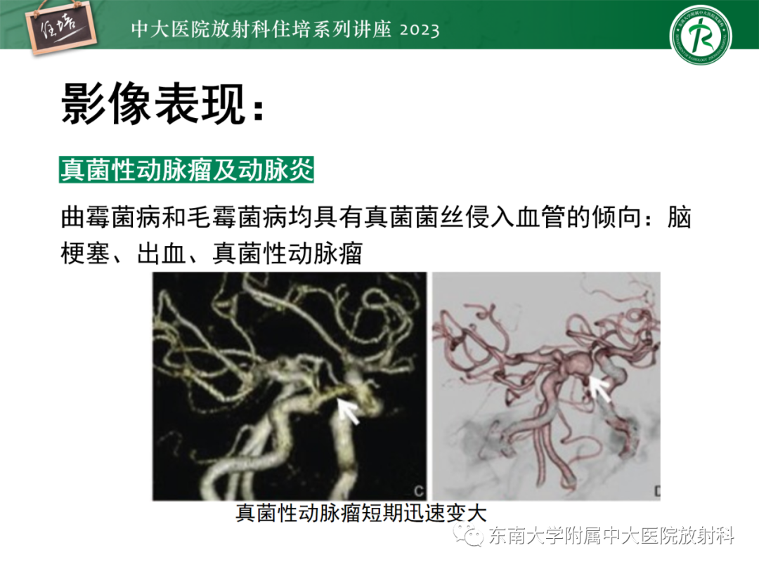 影像PPT - 【PPT】中枢神经系统真菌感染影像诊断-25