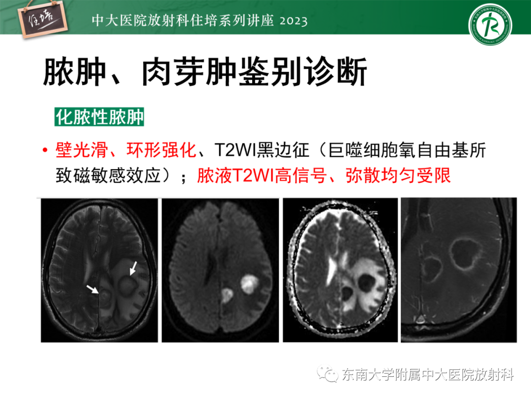 影像PPT - 【PPT】中枢神经系统真菌感染影像诊断-26