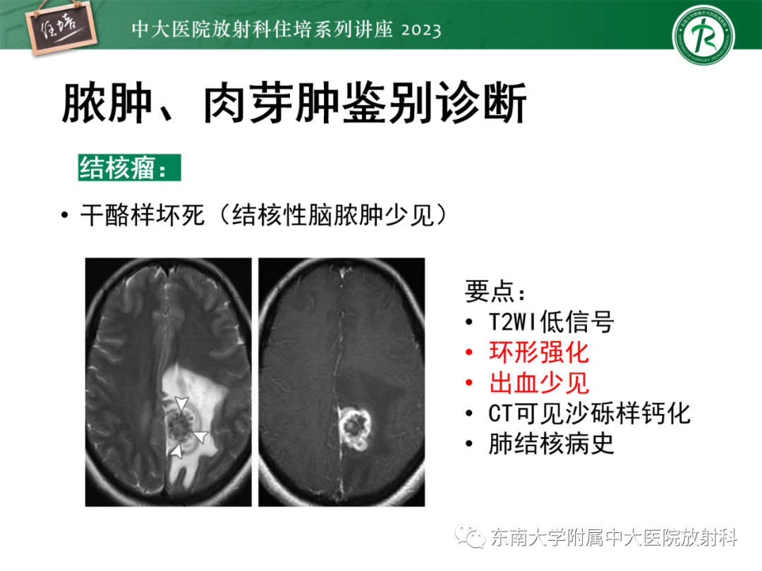 影像PPT - 【PPT】中枢神经系统真菌感染影像诊断-27