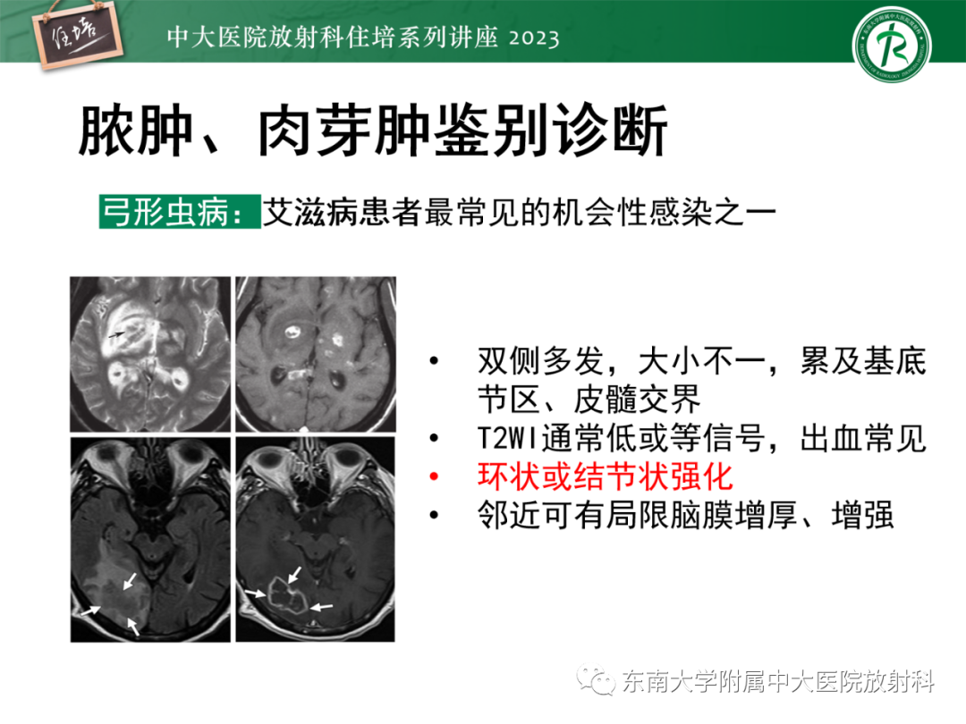 影像PPT - 【PPT】中枢神经系统真菌感染影像诊断-28