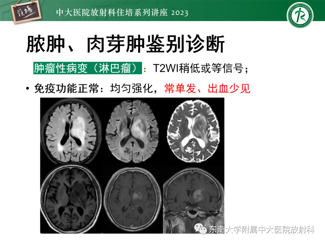 影像PPT - 【PPT】中枢神经系统真菌感染影像诊断-29
