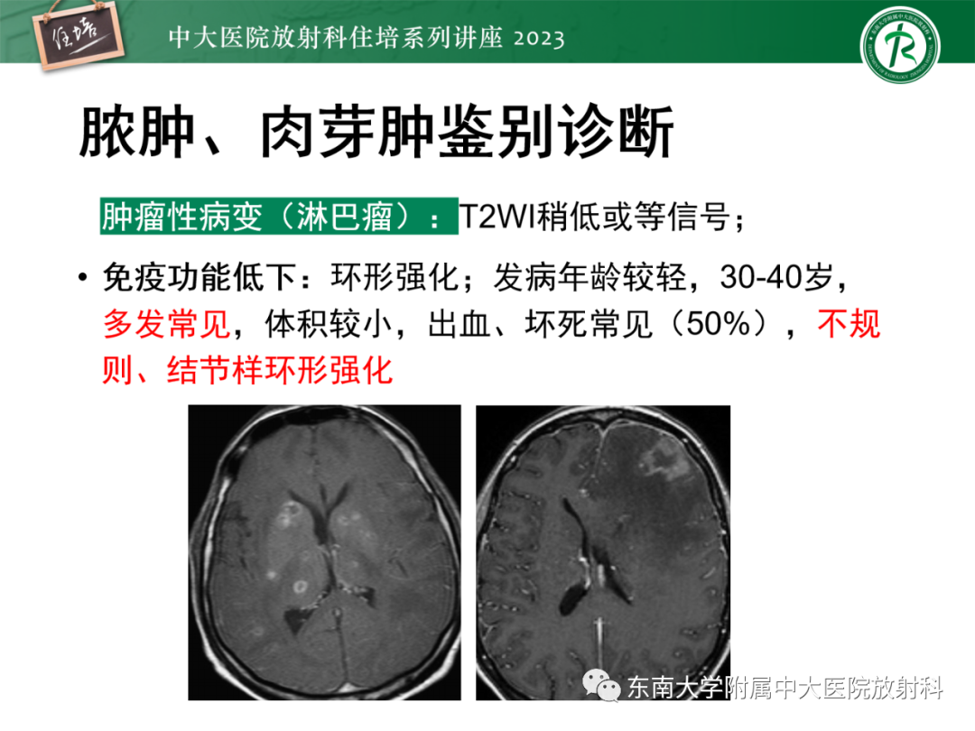 影像PPT - 【PPT】中枢神经系统真菌感染影像诊断-30