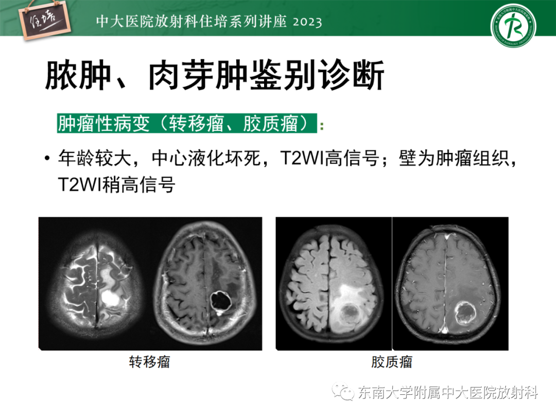 影像PPT - 【PPT】中枢神经系统真菌感染影像诊断-31
