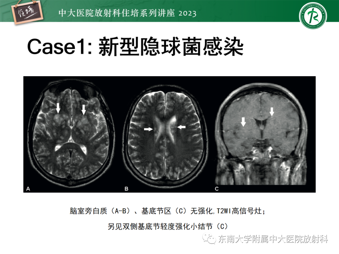 影像PPT - 【PPT】中枢神经系统真菌感染影像诊断-32
