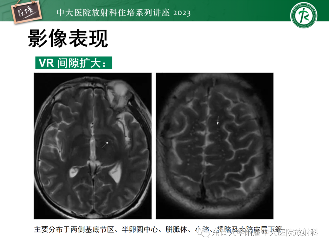 影像PPT - 【PPT】中枢神经系统真菌感染影像诊断-33