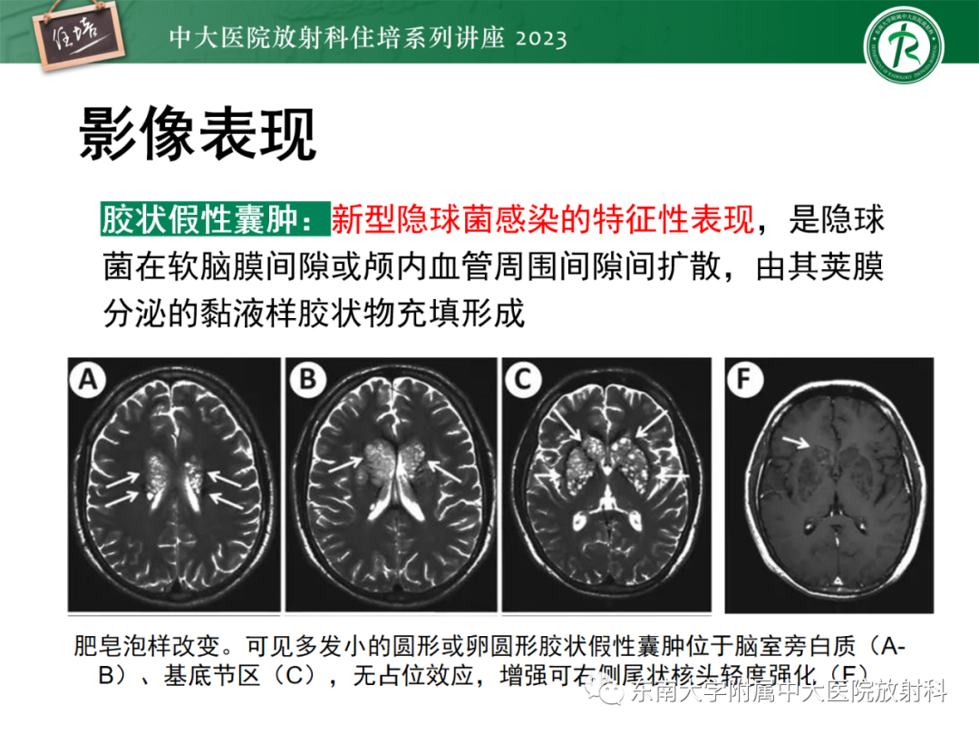 影像PPT - 【PPT】中枢神经系统真菌感染影像诊断-34