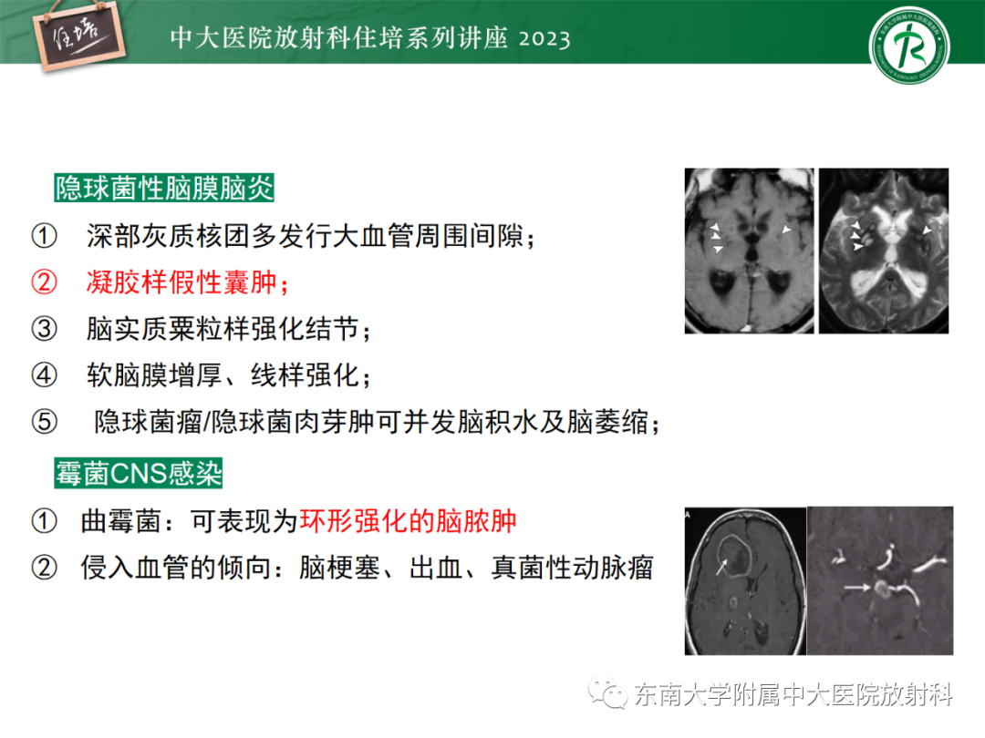 影像PPT - 【PPT】中枢神经系统真菌感染影像诊断-37