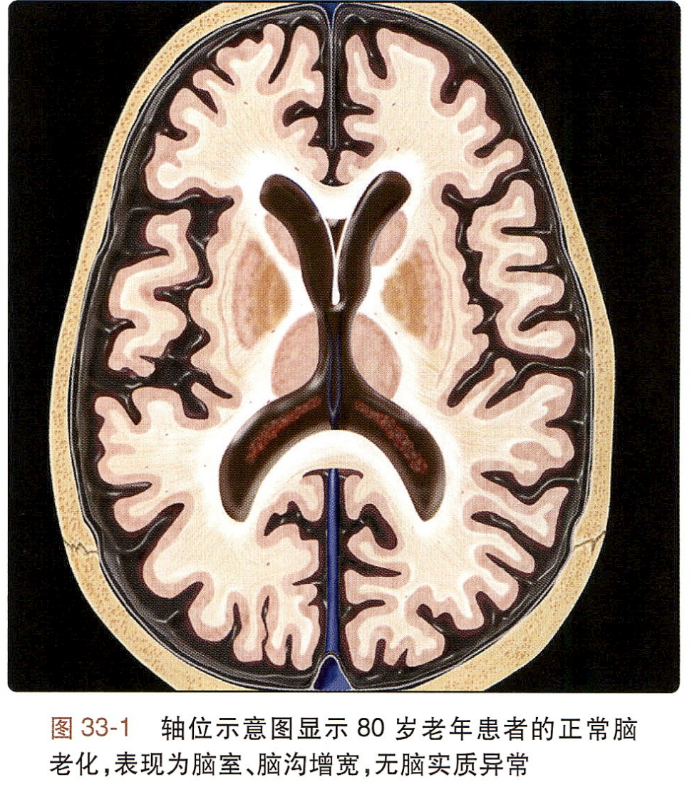 影像PPT - 老年人侧脑室前角的此类高信号,是正常征象-2 影像PPT - 老年人侧脑室前角的此类高信号,是正常征象-2