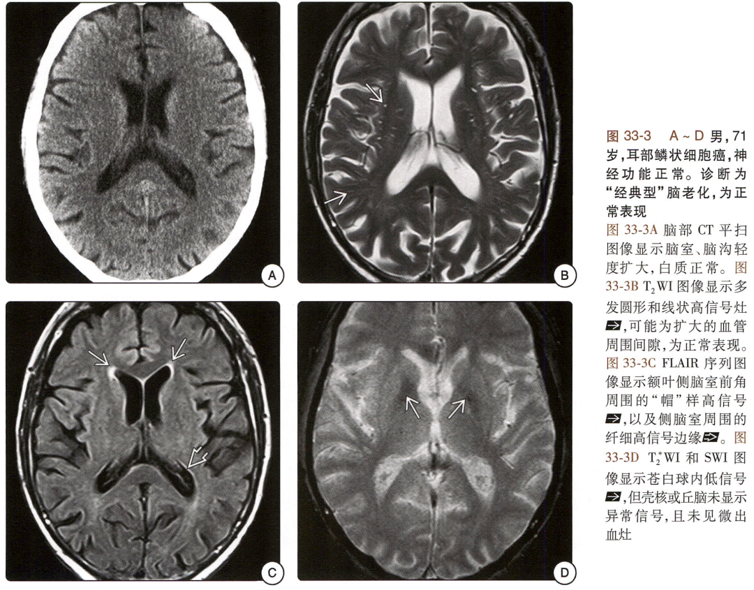 影像PPT - 老年人侧脑室前角的此类高信号,是正常征象-3 影像PPT - 老年人侧脑室前角的此类高信号,是正常征象-3