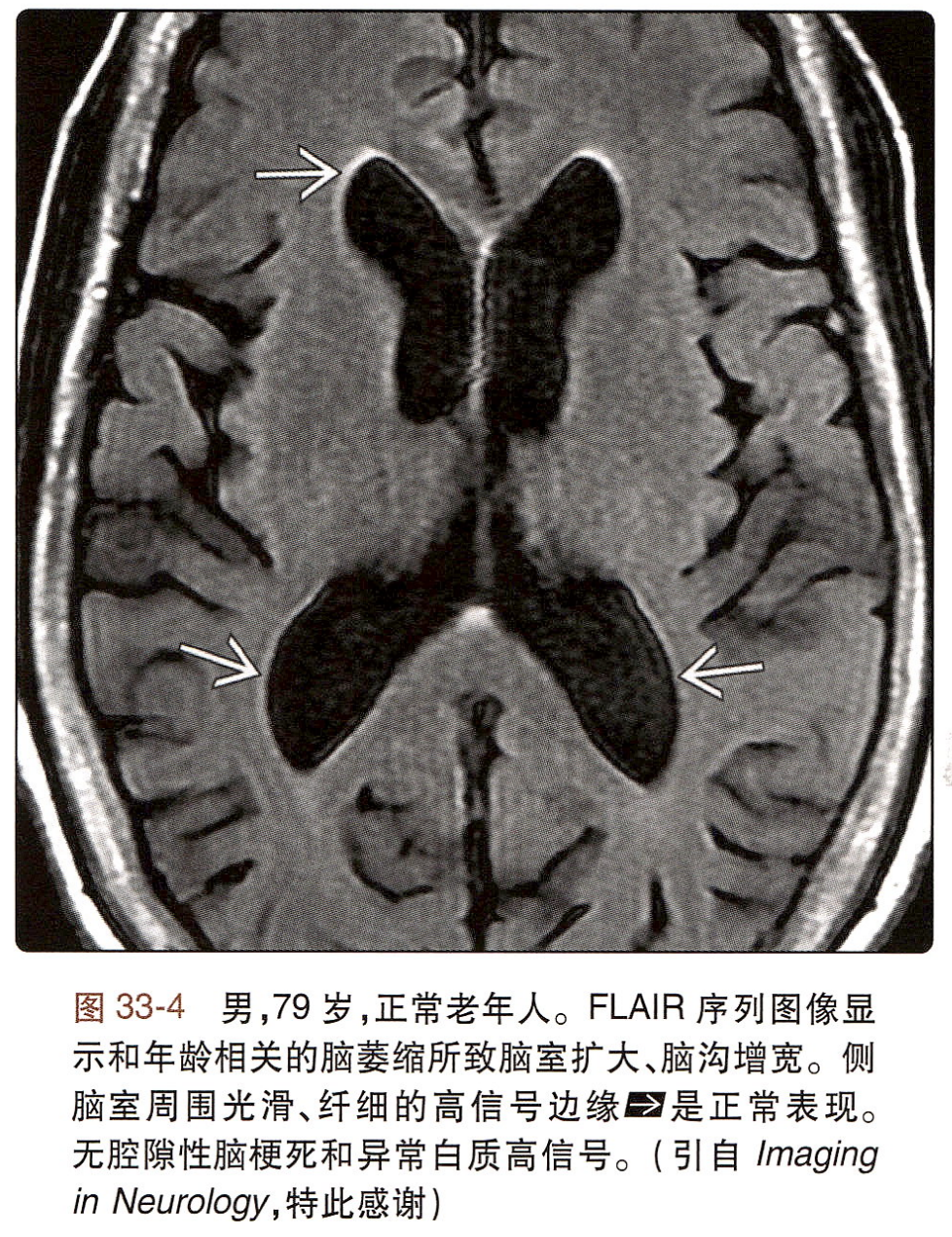 影像PPT - 老年人侧脑室前角的此类高信号,是正常征象-4 影像PPT - 老年人侧脑室前角的此类高信号,是正常征象-4