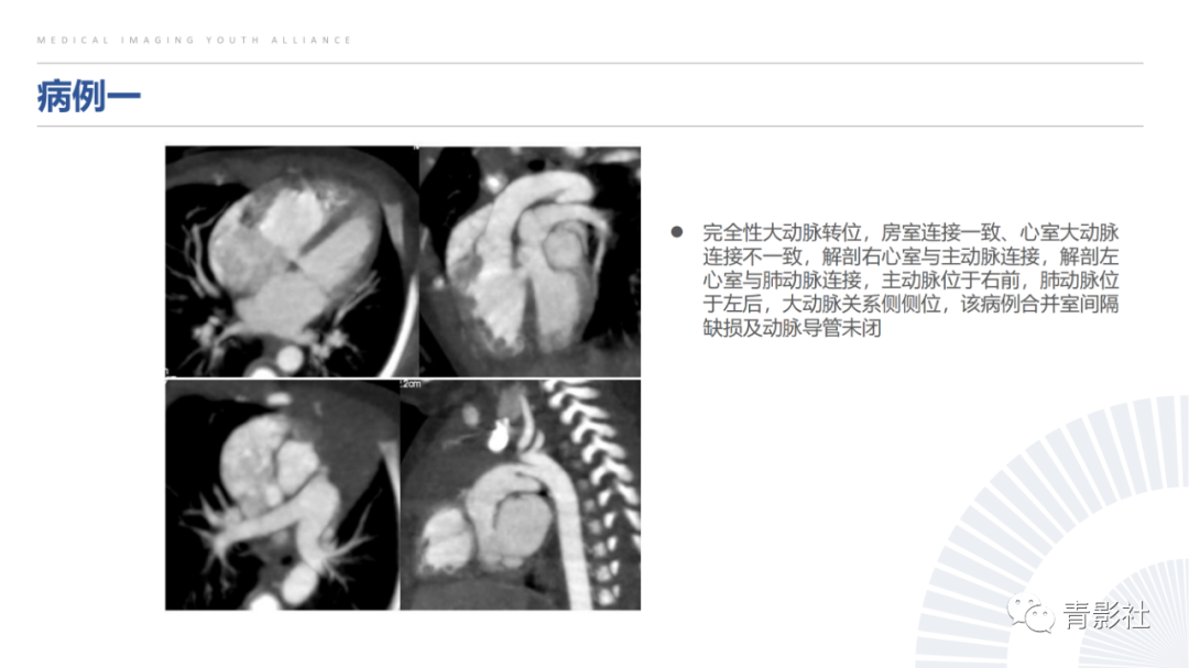影像PPT - 【PPT】心室大动脉连接异常的先心病的鉴别诊断-10