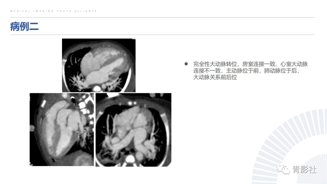 影像PPT - 【PPT】心室大动脉连接异常的先心病的鉴别诊断-11
