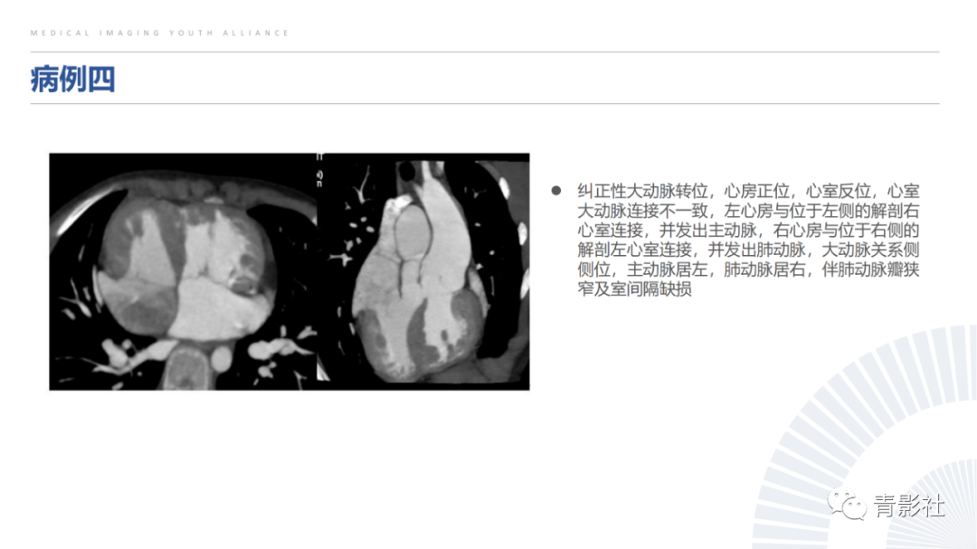 影像PPT - 【PPT】心室大动脉连接异常的先心病的鉴别诊断-14