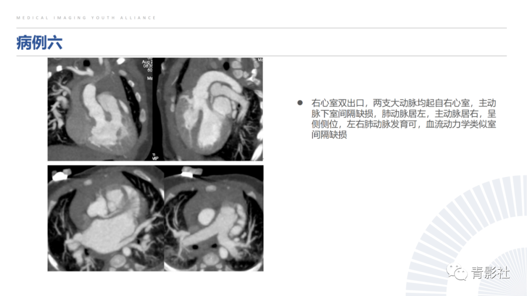影像PPT - 【PPT】心室大动脉连接异常的先心病的鉴别诊断-17