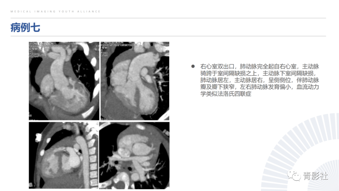 影像PPT - 【PPT】心室大动脉连接异常的先心病的鉴别诊断-18