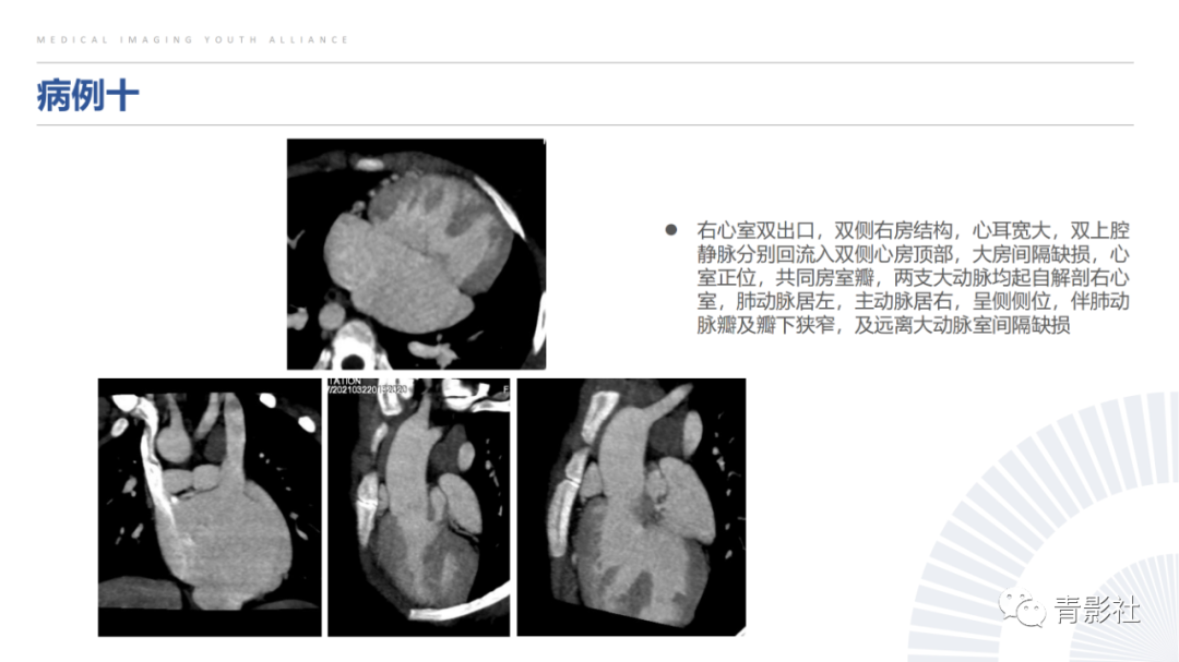 影像PPT - 【PPT】心室大动脉连接异常的先心病的鉴别诊断-21