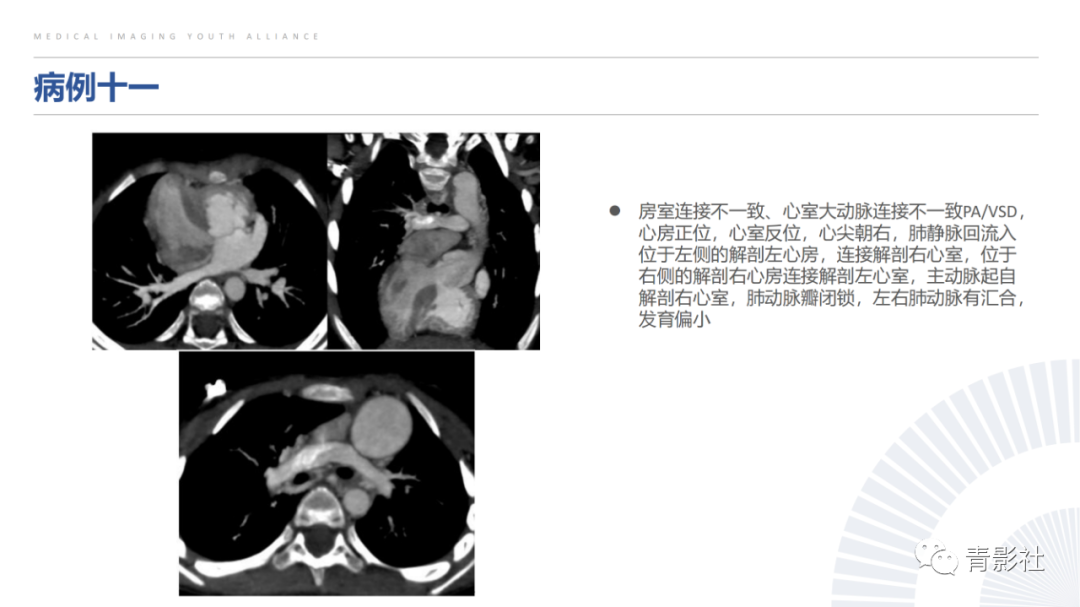 影像PPT - 【PPT】心室大动脉连接异常的先心病的鉴别诊断-23