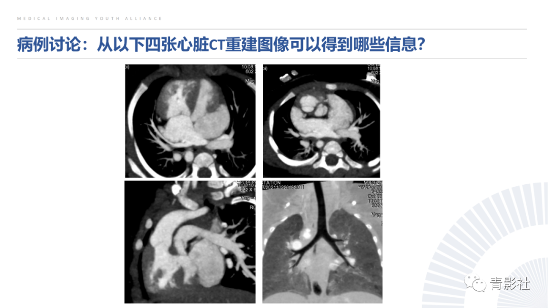 影像PPT - 【PPT】心室大动脉连接异常的先心病的鉴别诊断-32