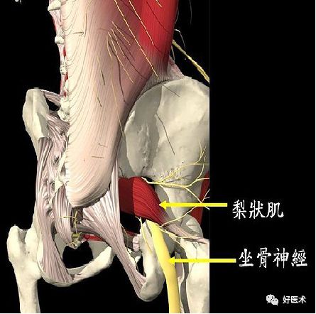 影像PPT - 梨状肌综合征-2 影像PPT - 梨状肌综合征-2
