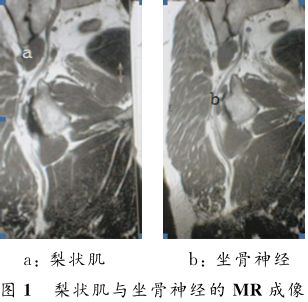 影像PPT - 梨状肌综合征-24 影像PPT - 梨状肌综合征-24