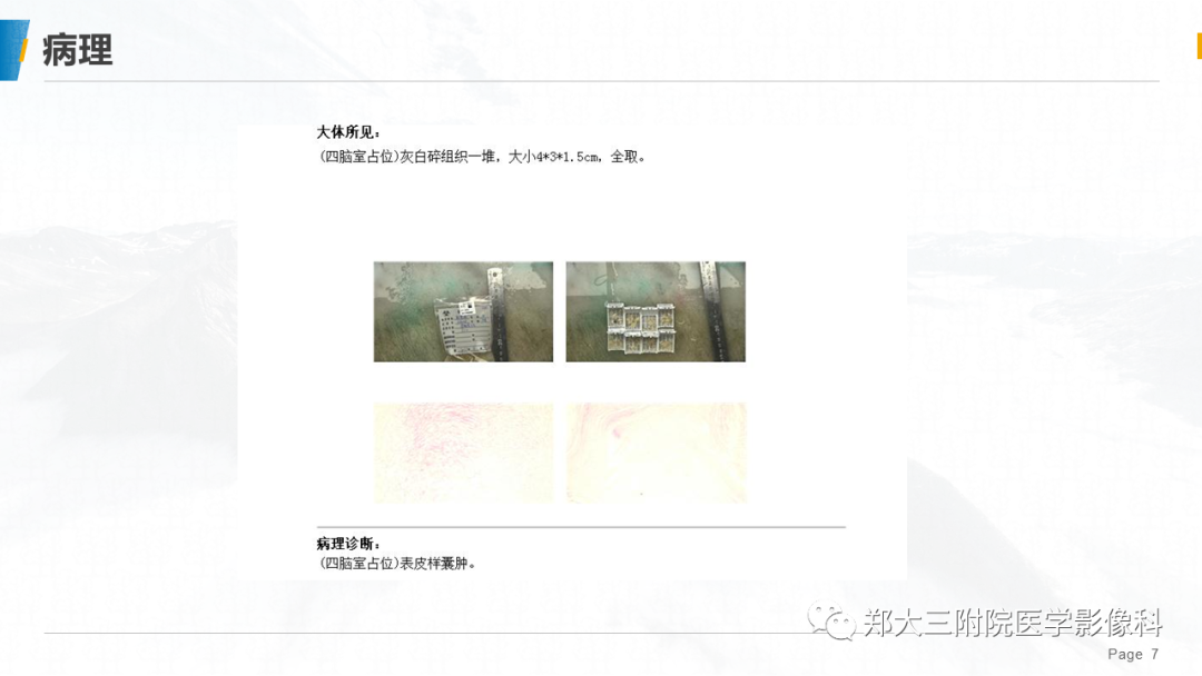 影像PPT - 【PPT】颅内表皮样囊肿-7