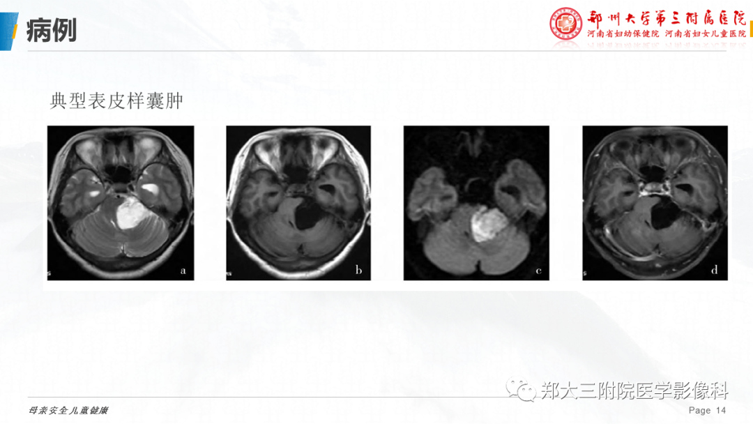 影像PPT - 【PPT】颅内表皮样囊肿-14
