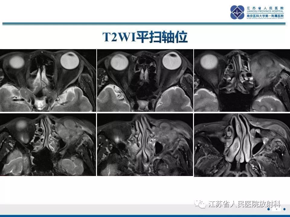 影像PPT - 【PPT】腺样囊腺癌-3