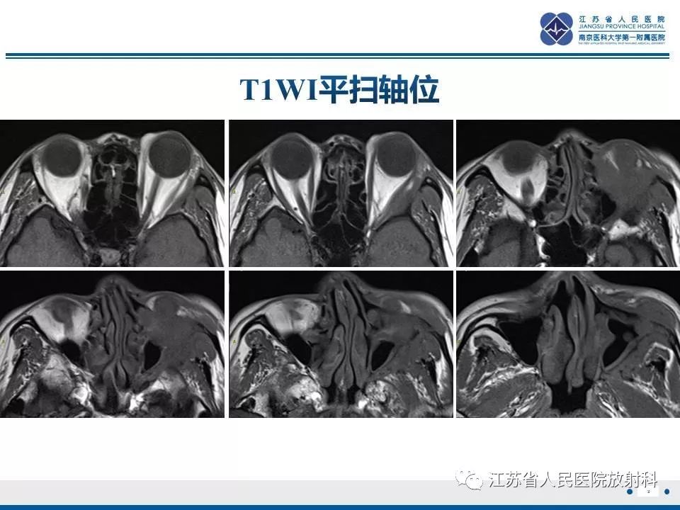 影像PPT - 【PPT】腺样囊腺癌-4