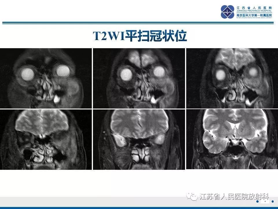 影像PPT - 【PPT】腺样囊腺癌-5